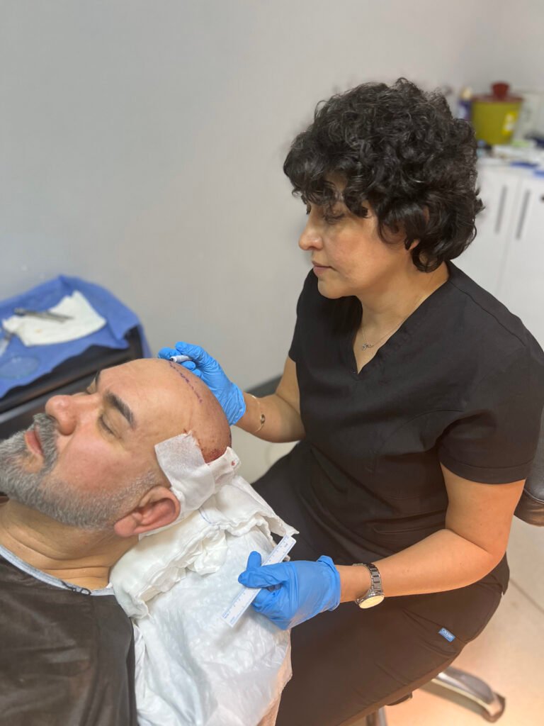 Sapphire FUE hair transplant