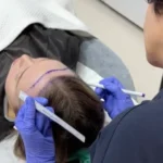 Hair Transplant for women