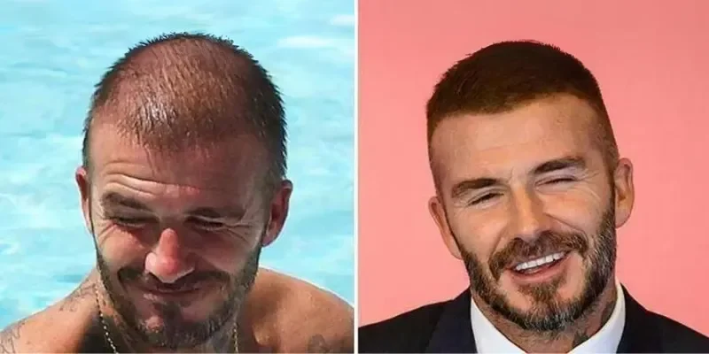 David Beckham Hair Transplant