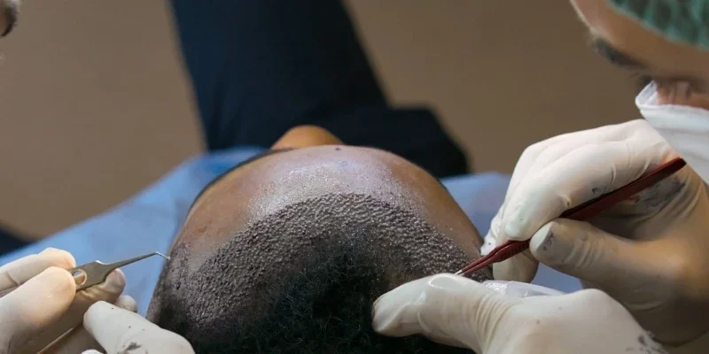 Afro hair transplant procedures