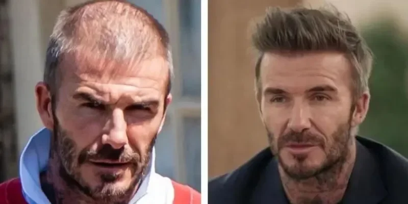 David Beckham Hair Transplant