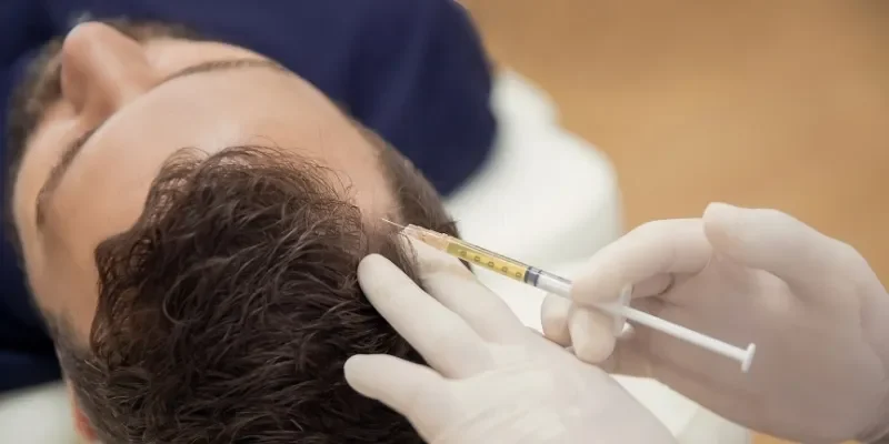 PRP Mesotherapy for Hair Loss